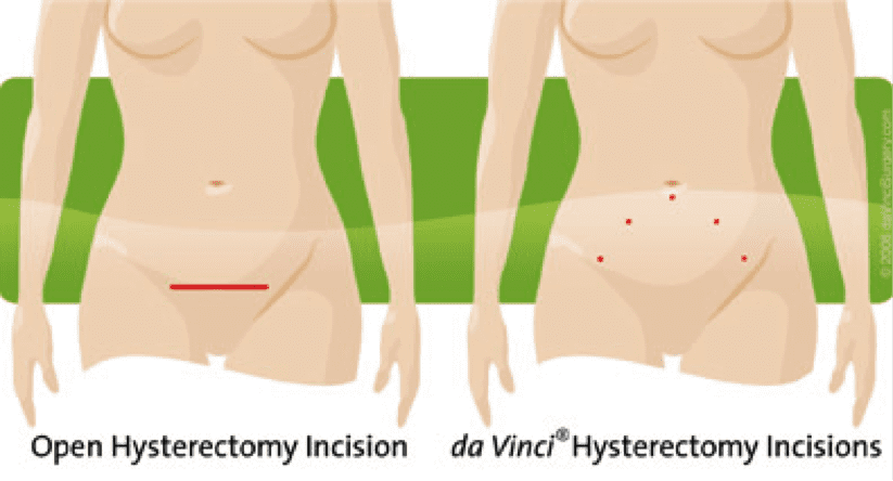illustration of incision types, standard vs. da Vinci, on women's abdomen