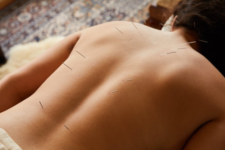 acupuncture
