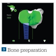Bone preparation