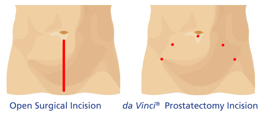 Illustration of types of incisions, standard vs. da Vinci, on a male's abdomen