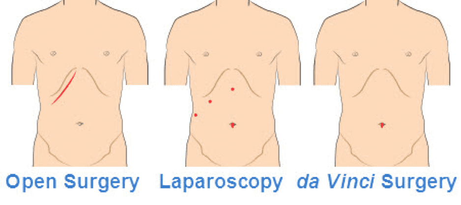 Illustration of three types of surgery, traditional open surgery vs. Laparoscopy vs. da Vinci surgery