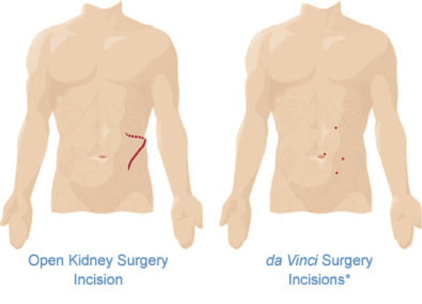 Illustration of open kidney surgery incision vs. da Vinci surgery incision on male body
