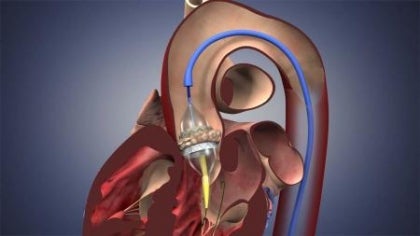 photo of artifical heart valve on balloon photo of artifical heart valve on balloon