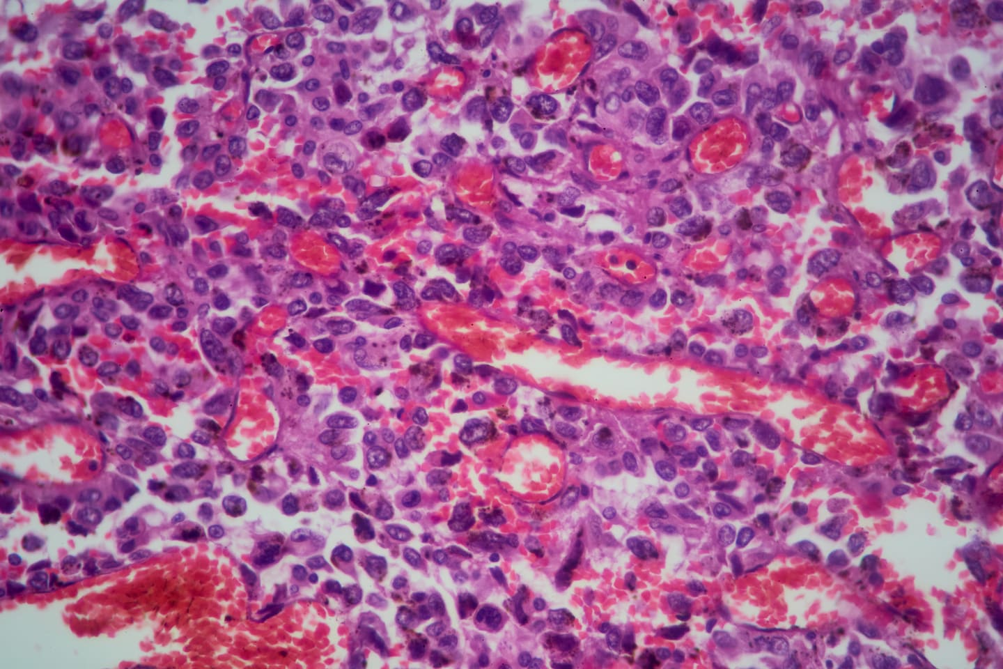 Magnified sample of lung tissue displaying adenocarcinoma. (iStock)
